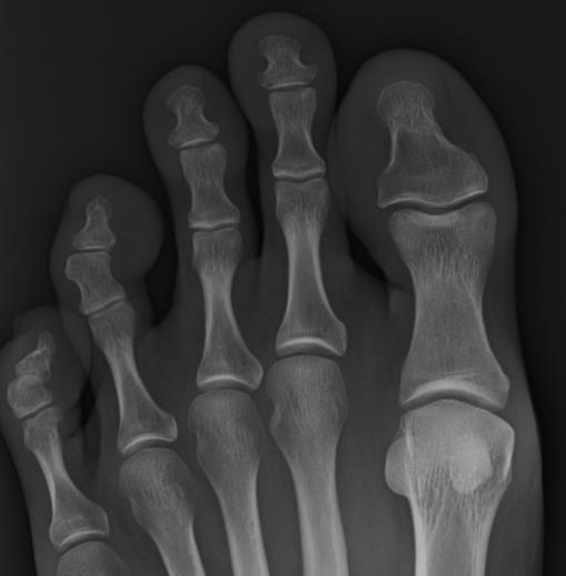 1. JOHDANTO Mortonin jalka (Mortonin varvas) tarkoittaa jalkaterän anatomista poikkeavuutta, jossa isovarpaan metatarsaali (jalkapöydänluu) on lyhyt suhteessa toisen varpaan metatarsaaliin.
