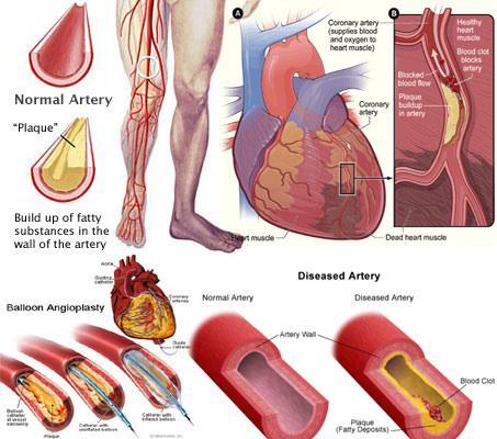 Fysiikka: VERENPAINE TAUSTAA Verenpaine on paine, joka kohdistuu verisuonten seinämiin verenkierrossamme. Yläpaine (systolinen) on suurin paine, joka kohdistuu verisuonten seinämiin.