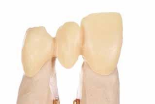 Jos dentiiniä (ydinmateriaalia) on poistettu liikaa, voidaan käyttää dentiiniposliinia ja tehdä viimeistely kiilleposliinilla.