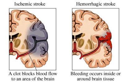 Aivoinfarkti - Aivokudoksen pysyvä vaurio, joka johtuu vaillinaisesta verenvirtauksesta tai