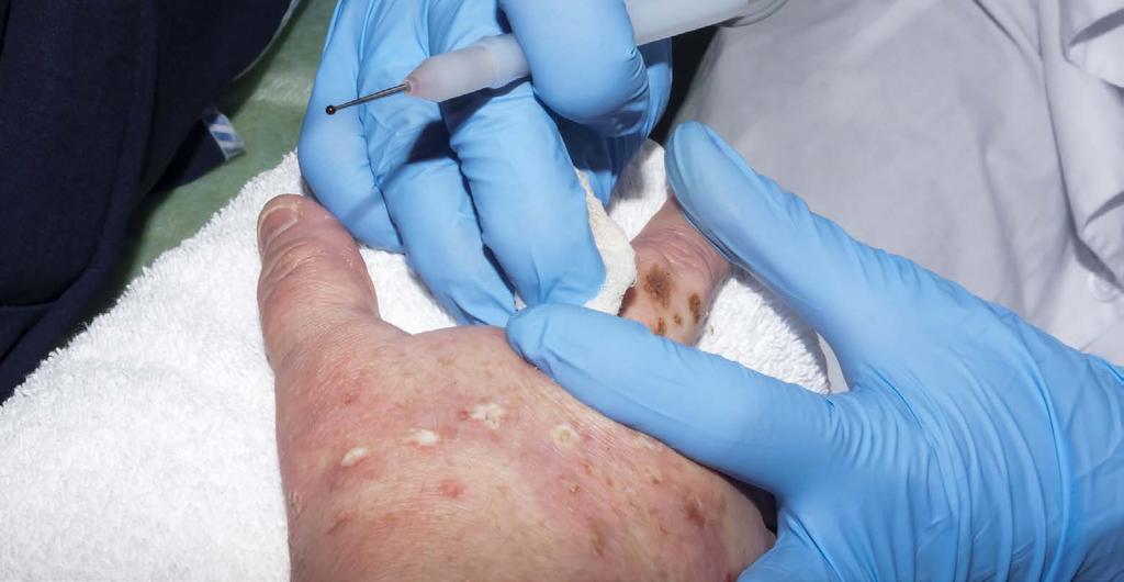 Ihosairauksien eurooppalainen verkosto (ERN Skin) 34 Monet ihosairaudet vaikuttavat suuresti potilaisiin, ja niihin voi liittyä syöpäriski.