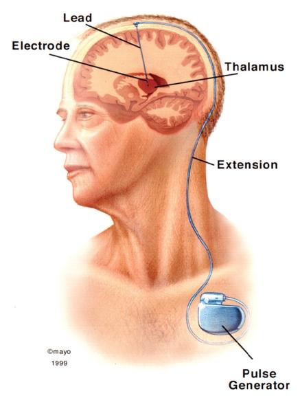 Parkinson-potilaan perioperatiivinen hoito Ø Minimoi lääketauko à malignia neuroleptisyndrooma muistuttava oireisto Ø puudutusten suosiminen Ø lääkkeet nenä-mahaletkuun Ø Huolehdi lämpötaloudesta Ø