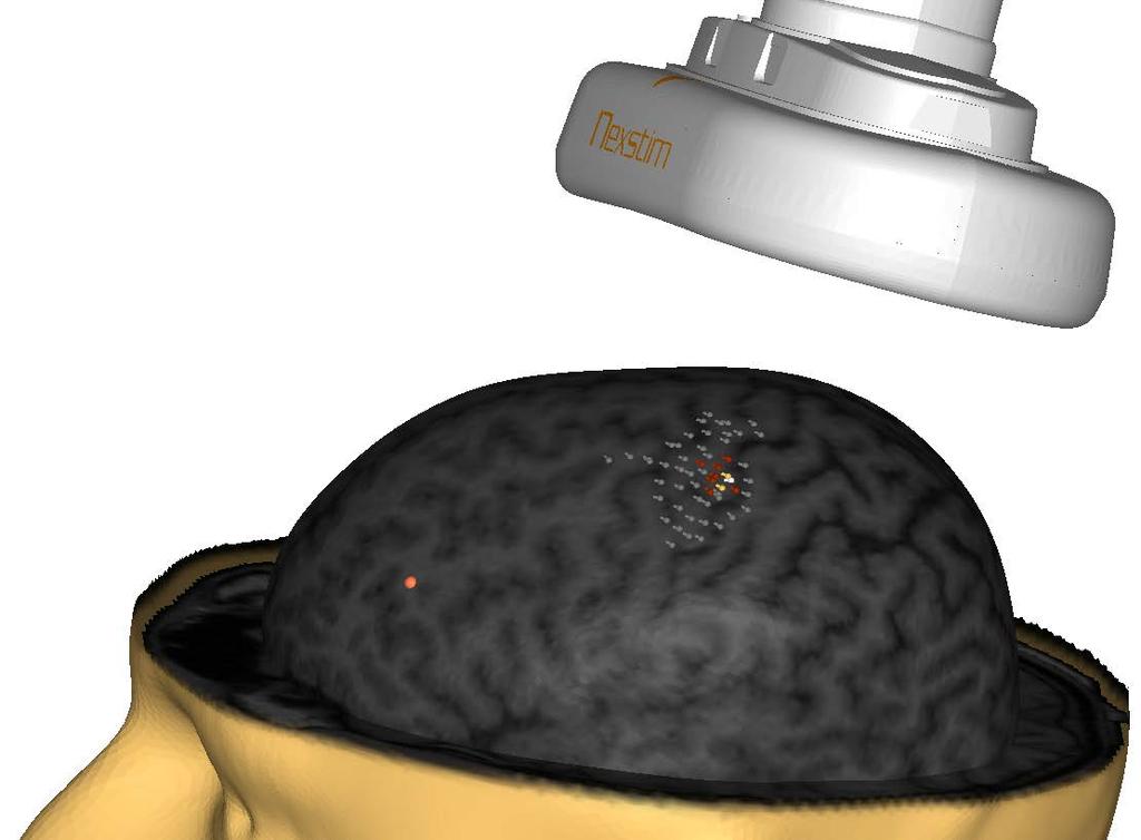 NBT potilaskohtainen hoitomenetelmä Magneettistimulaatio Sähkökentän enimmäisvaste Aivojen etuotsalohko Dorsolateraalinen