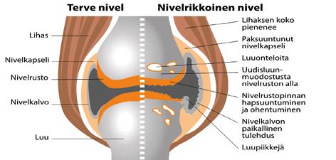 Nivelrikon tärkeimpiä oireita ovat kipu sekä liikkumisen vaikeudet. Oireita lievitetään ensisijaisesti lääkkeillä ja liikunnalla.