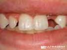 Muotit on suunniteltu jäljittelemään hampaiden anatomiaa esteettisen hammashoidon ja "kultaisen leikkauksen" sääntöjen