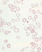 PUNASOLUINDEKSIT punasolujen kromisuus MCH (E MCH: 27-33 pg/solu) Punasolujen keskimääräinen