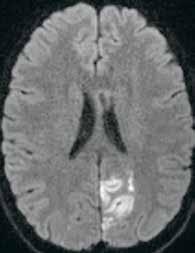Pään TT oli hoitojen jälkeen normaali. A B C KUVA 2. Nuoren aivoinfarktipotilaan aivoinfarktin taustalla todettiin Sjögrenin oireyhtymään liittyvä vaskuliitti.