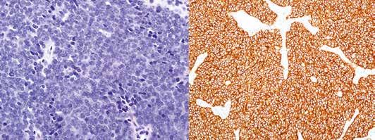 A B KUVA 3. Histologisesti Ewingin sarkooma muodostuu niukkasolulimaisista pyöreätumaisista soluista, jotka eivät muodosta rakenteita.