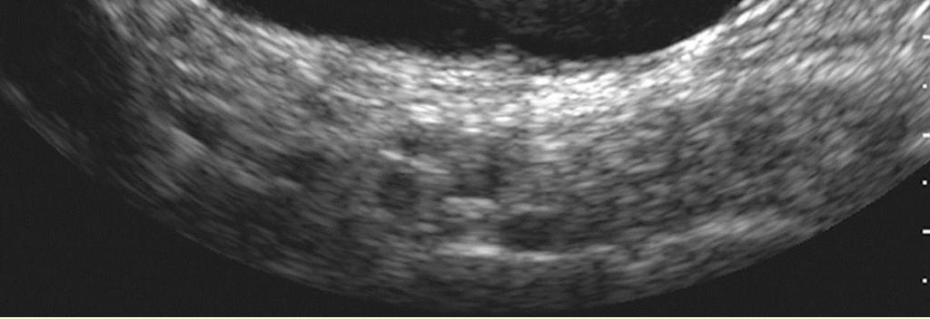 Hysterosalpingosonografia (HSSG) alkukierrossa (PD 4-10)