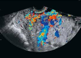 Poikkeavat löydökset painottuvat erityisesti kohdun alaosaan. Istukan lammikoissa (placental lacunae) nähdään valtimovirtausta ja istukka-virtsarakkorajapinnassa runsaat uudissuonimuodostelmat.