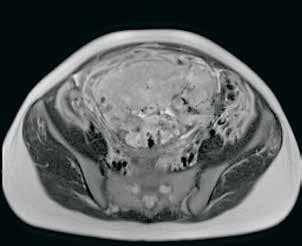 A B * * KUVA 3. Magneettikuvaus raskausviikolla 25+5. Kyseessä sama potilas kuin kaikukuvassa. Aksiaali- ja sagittaalisuunnan T2-painotteinen niin sanottu single-shot turbo spin-echo -sekvenssi.