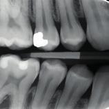 3 Duraphat 22,6 mg/ml dentaalisuspension annostelemisen on osoitettu vähentävän alkavia valkoisia
