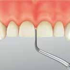 V-TIP SYSTEM (restauraatiot) Restauraatiot (kruununpreparoinnit) V-TIP (endodontia) Voidaan