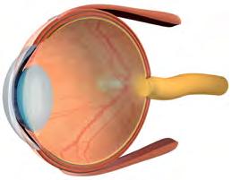 LHON 2.3 Leberin perinnöllinen näköhermorappeuma Leberin perinnöllinen näköhermorappeuma (LHON) on yksi yleisimmistä mitokondrio-oireyhtymistä.