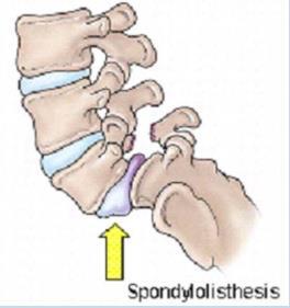 spondyolyysi on ajan kanssa kehittyvä rasitusmurtuma, joka johtuu jatkuvasta lannerankaan kohdistuvasta rasituksesta. (Thein-Nissenbaum & Boissonnault 2005, 319.) 28 6.