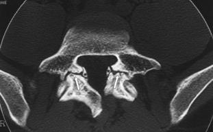 arvioimaan spondylolyysin ikä. Jos TT-tutkimuksessa murtumalinja on kovettunut tai pyöristynyt, kyseessä on todennäköisesti vanha rasitusmurtuma.