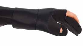 turvotusta kädessä ja käsivarressa. Näiden komplikaatioiden seurauksena voi käden liikkuvuus heikentyä ja lopulta johtaa kontraktuuraan - käden ja sormien koukku-virheasentoon (kuva A).