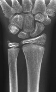 2-3 Käden ja ranteen kuvantaminen Natiiviröntgenkuvaukset (RTG) Käden kuvantaminen muodostaa tärkeän osan radiologian historiaa, sillä ensimmäinen röntgenkuva ihmisestä otettiin kädestä: William