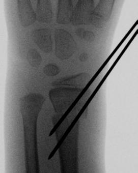 II Käden anatomia ja tutkiminen sekä käsikirurgian yleiset periaatteet B A Kuva 2. Skafolunaarinen dissosiaatio. Ranteen ollessa neutraaliasennossa skafolunaarinen väli on leveydeltään normaali (a).