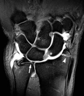 II Käden anatomia ja tutkiminen sekä käsikirurgian yleiset periaatteet Kuva 5. Artrografia ranteen ligamenttivammoissa.