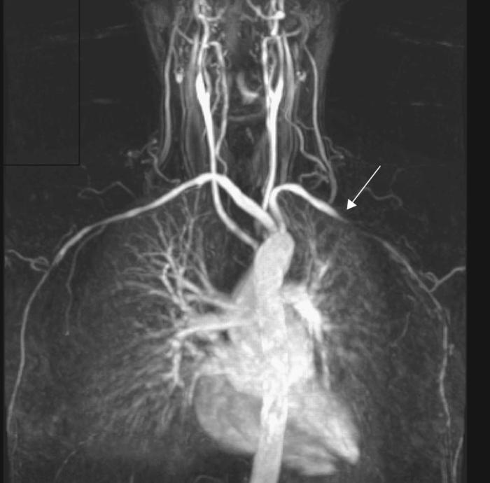 carotiksen haaroja 10-15 %:lla muissa valtimoissa (pulmonaalivaltimot: