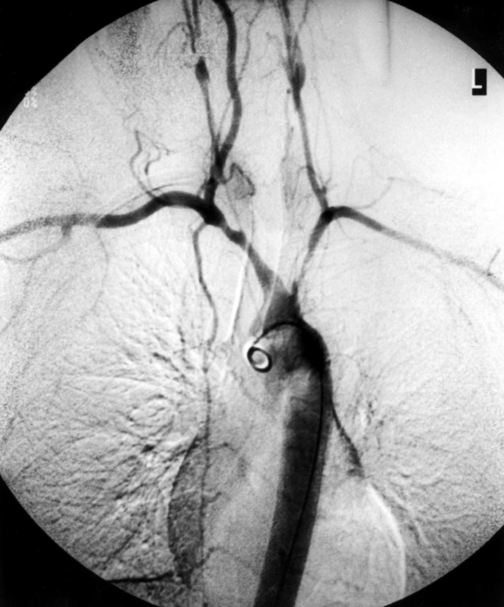 Takayasun arteriitti yleensä affisioi aortaa ja sen haaroja puolella