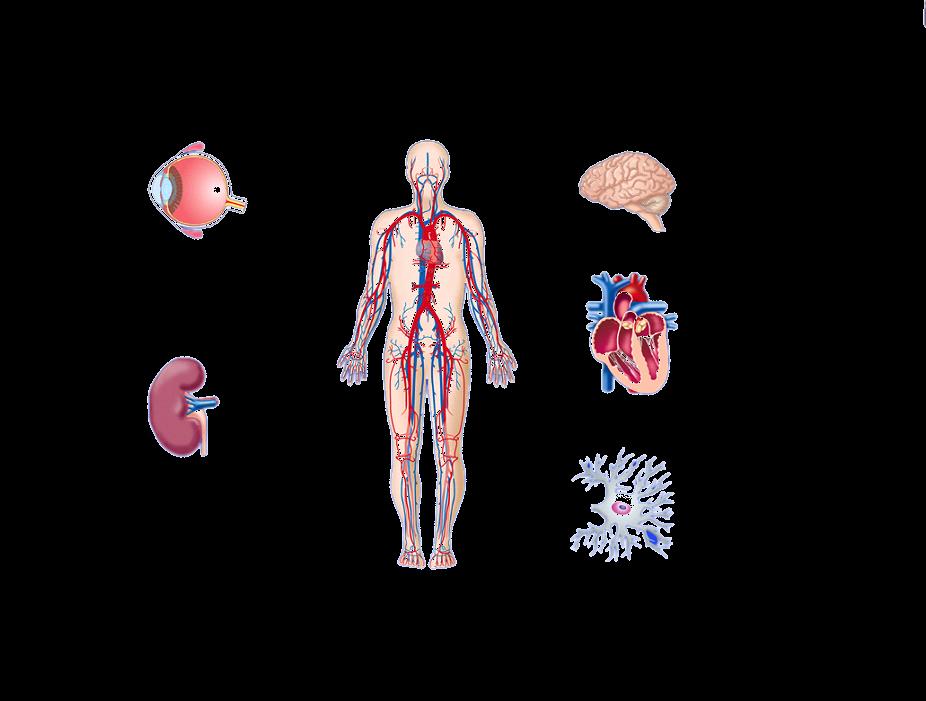 Diabetes ja komplikaatiot Diabeettinen Diabetic retinopatia retinopathy Leading cause of blindness in working-age adults 1 Diabetic nephropathy Diabeettinen nefropatia Leading cause of end-stage