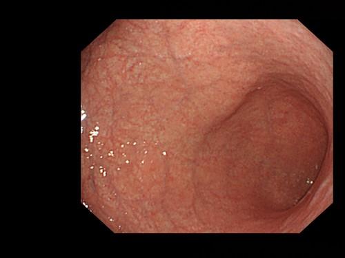 Atrofinen gastriitti Limakalvon rahasten väheneminen- katoaminen Helikobakteeri