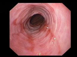 Esofagiitti Histologialla reflksitadin diagnostiikassa ei merkitystä Eosinofiilinen esofagiitti