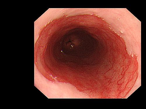 lieriöepiteeli (gastrinen tai intestinaalinen