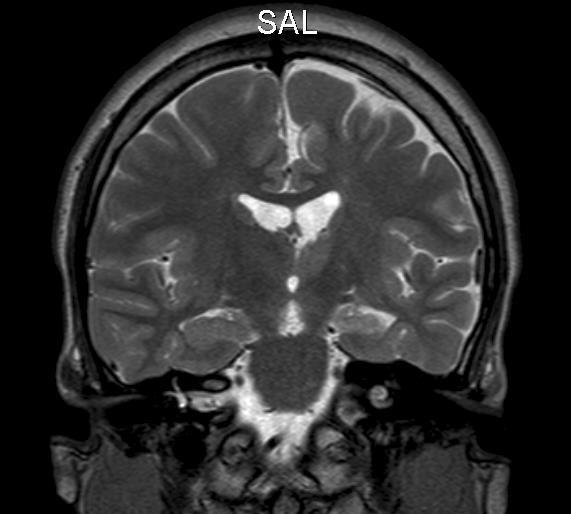 Ohimolohkoepilepsia-