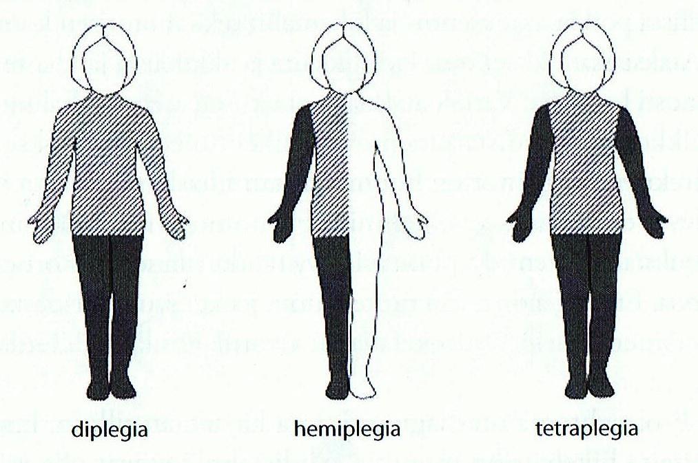 16 Spastisen tetraplegian osuus on noin 10 15 % kaikista CP-oireistoista. Tetraplegiassa liikuntavamma vaikeuttaa yläraajojen motoriikkaa yhtä vaikeasti tai enemmän kuin alaraajojen motoriikkaa.