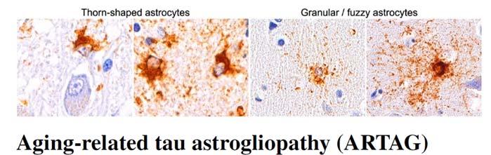 argyrophilic grains