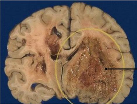 Neuropatologia Sairauden