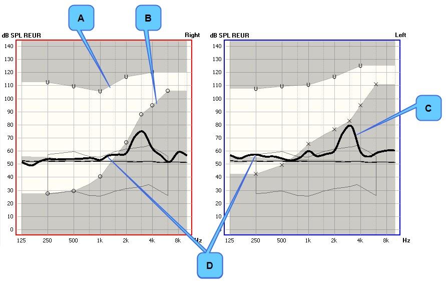 A. UCL B. Audiogrammi C. Huippu noin 3 khz:ssä D. Mittakäyrä 13.