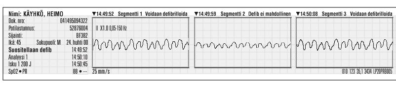 00 Tarkista potilas 14:49:52 II Tarkista potilas LT -- SpO2 89 Tarkista potilas -tapahtuma x1,0 0,05-150 Hz 25 mm/sek 010 123 35.1 3434 LP20PRB005 Nimi: KÄYHKÖ, HEIMO Dok. Nr.