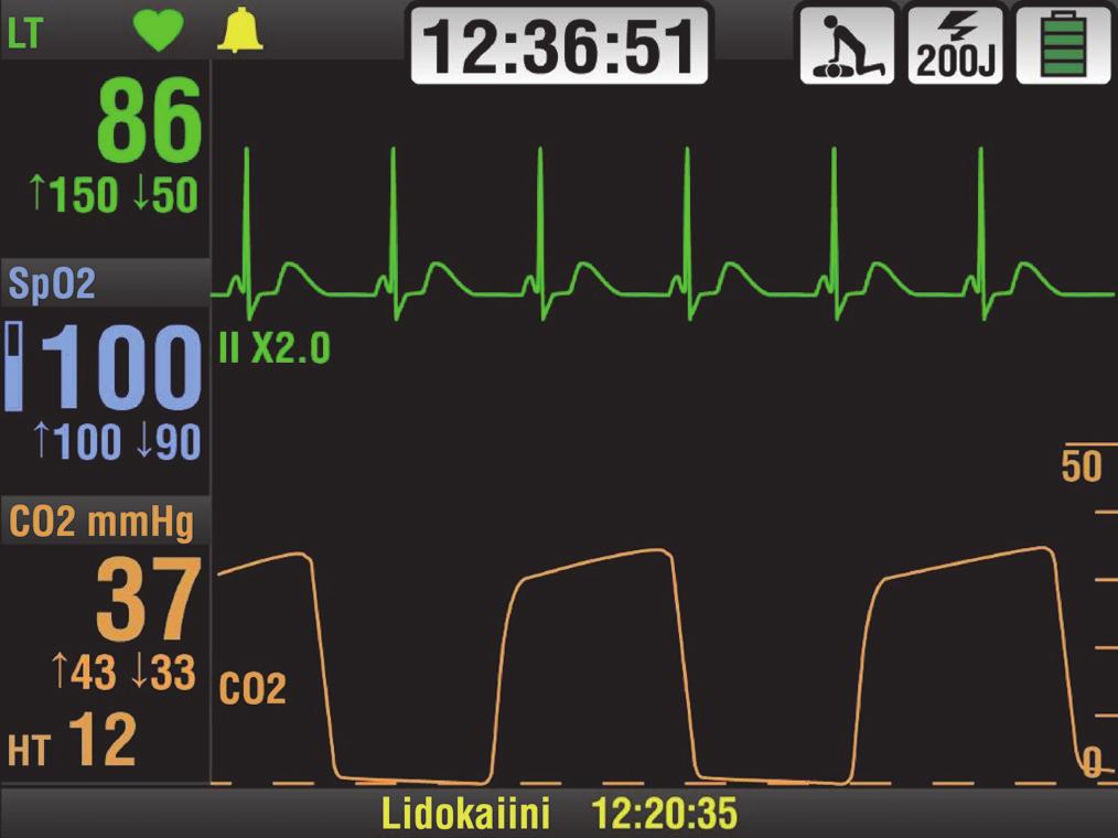 Perustietoja Hälytyskuvake Elvytysmetronomikuvake Valittu energia Akun tilan ilmaisin Aikanäyttö TARKKAILUPA RAMETRIEN ALUE Näyttää potilasarvot ja hälytysrajat.
