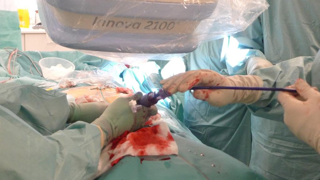 3.9 Säteilysuojelu TAVI- ja MitraClip -toimenpiteissä 3.9.1 Yleistä Aorttaläpän asentaminen katetritekniikalla (Transcatheter Aortic Valve Implantation, TAVI) ja hiippaläppävuodon korjaus katetritekniikalla (esim.
