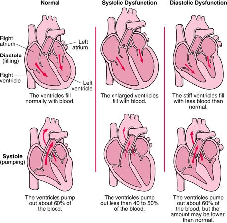 Systolinen vajaatoiminta: - Sydäninfarktin jälkitila -