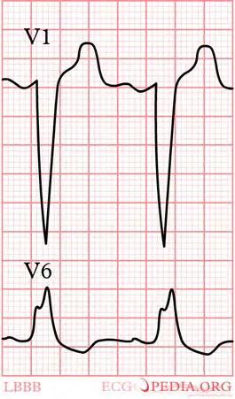 Vajaatoimintatahdistinhoito Iäkkäimmillä järkevää tyytyä selkeimpiin käyttöaiheisiin: 1) EF < 35% 2) Vasen haarakatkos ja QRS > 150 ms 3)