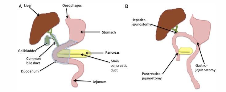 33 KUVA 7. Klassinen Whipplen toimenpide. (A) Leikkausta edeltävä anatomia, poistettava alue varjostettuna. (B) Leikkauksenjälkeinen anatomia (Gall ym. 2015). KUVA 8.