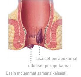 Peräpään vaivat Ulkoiset peräpukamat (K84.