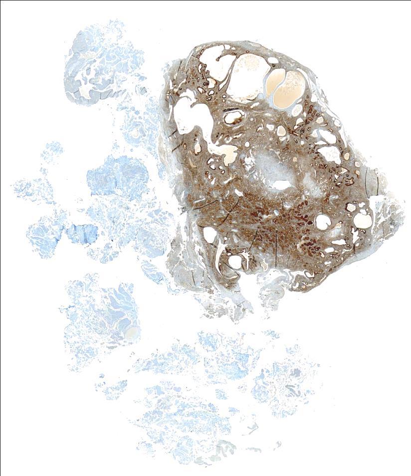 Estrogeenireseptori Endometriumin