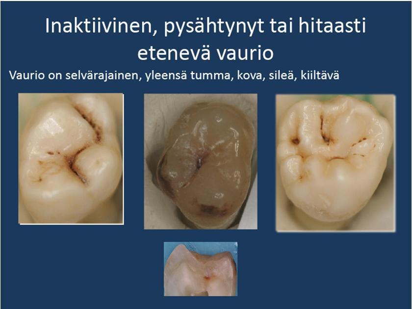 Demineralisaation syytekijöiden poistuessa mineraalit voivat saostua ja hampaan pinta kovettua uudestaan