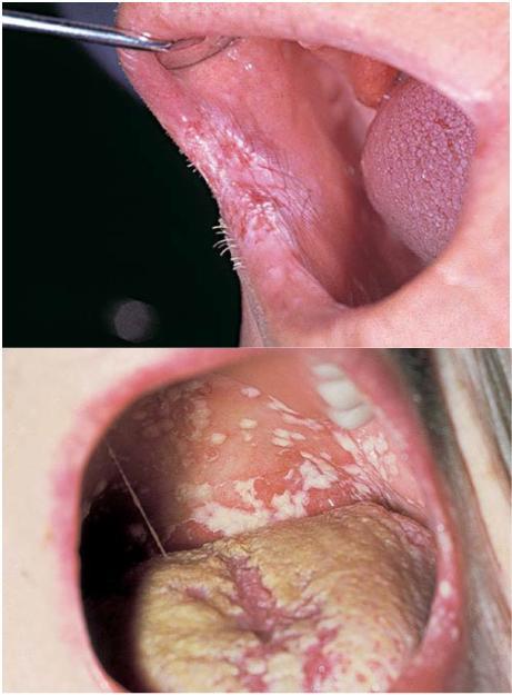 Suun mikrobit ja syöpä Suun mikrobiston muutokset on liitetty suusyöpävaaraa lisäävien limakalvomuutosten kehittymiseen syöväksi (Atanasova 2014) Tärkeänä karsinogeenisena mekanismina pidetään