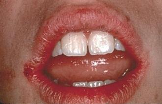 Kandidaviljely (CandVi): laji ja määrä Hoito: suuhygienian tehostaminen, plakin ja hammaskiven