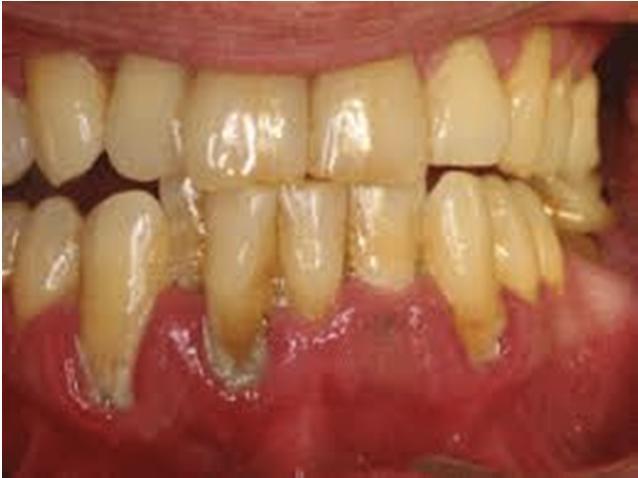 Kulmakivipatogeeni -konsepti Porphyromonas gingivalis kulmakivipatogeenina parodontiitissa: Patogeenia määrällisesti vähän, mutta pystyy häiritsemään biofilmin tasapainoa tehokkaasti: Erittää