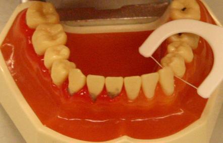 Hammaslangan käyttö Hammasharjalla ei yleensä päästä puhdistamaan tehok kaasti ahtaita hammasvälejä.