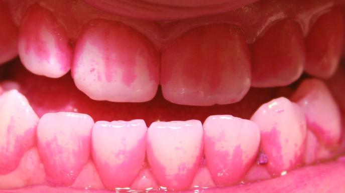 Plakkiväritablettitesti Plakkiväritestin avulla saadaan hampaiden pinnoilla oleva bakteeripeite eli biofilmi näkyväksi.