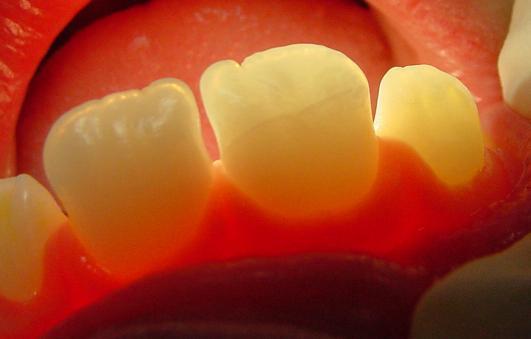 Hammastapaturmat jaotellaan lieviin, vaikeisiin, hampaan kovakudoksen vammoihin ja hampaan tukikudoksen vammoihin. Kovakudosvammoja ovat eriasteiset kruunumurtumat ja juurimurtumat.